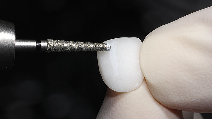 Dt News Mea Minimally Invasive Veneer Restoration With Hybrid Ceramics