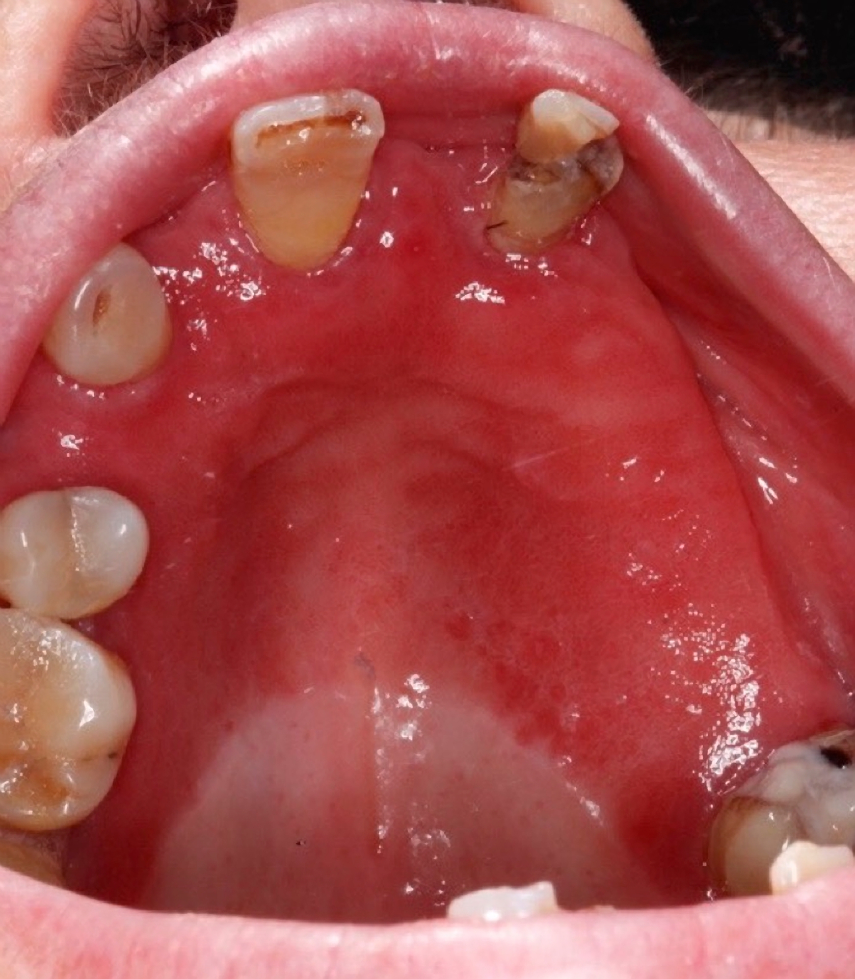 Lesiones De La Mucosa Oral En Pacientes Mayores