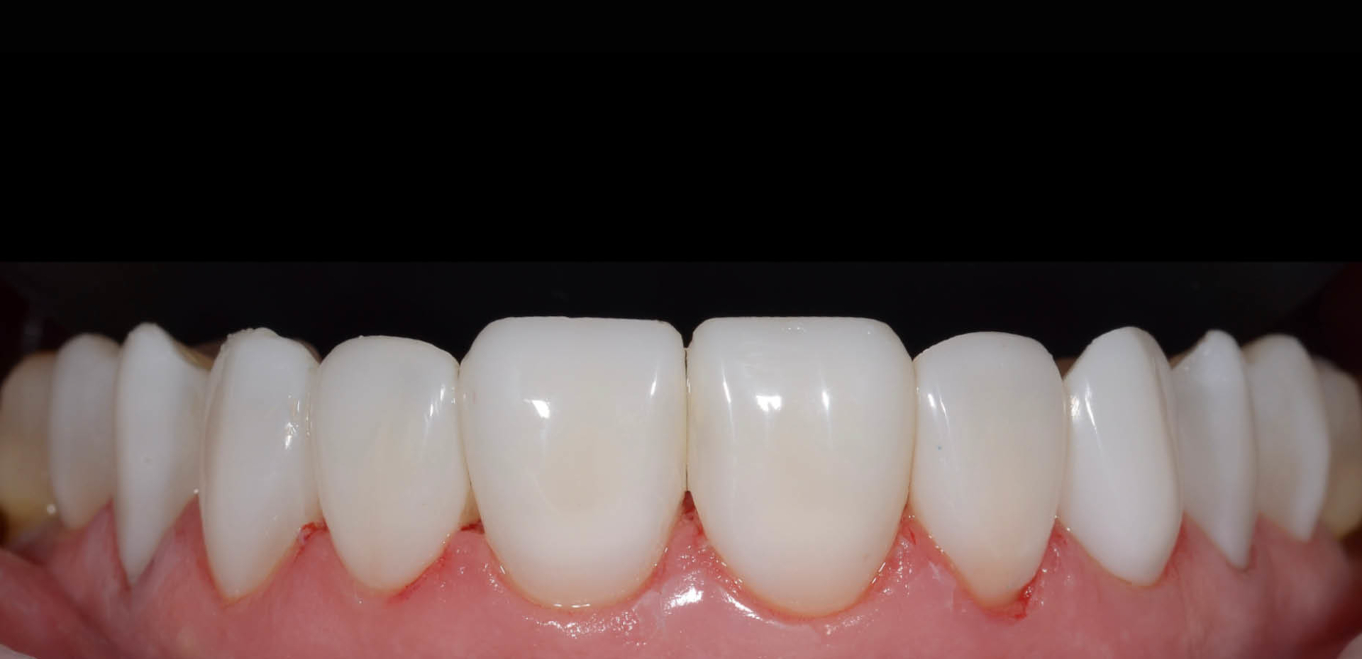 A Composite Revolution With Clearfil Majesty Es Flow Low