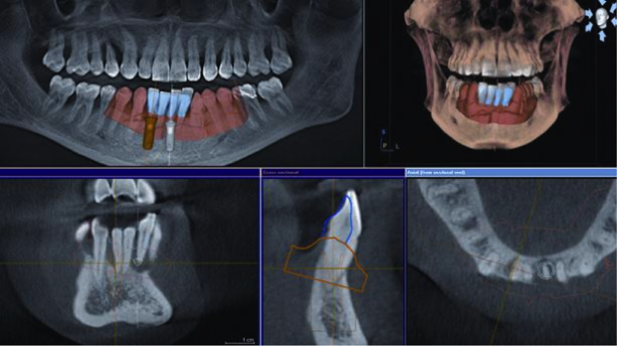 Клкт челюсти. КЛКТ В имплантологии.