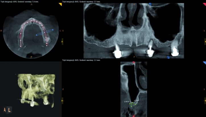 Dental News - The use of CBCT and CAD/CAM techniques in complex implant ...