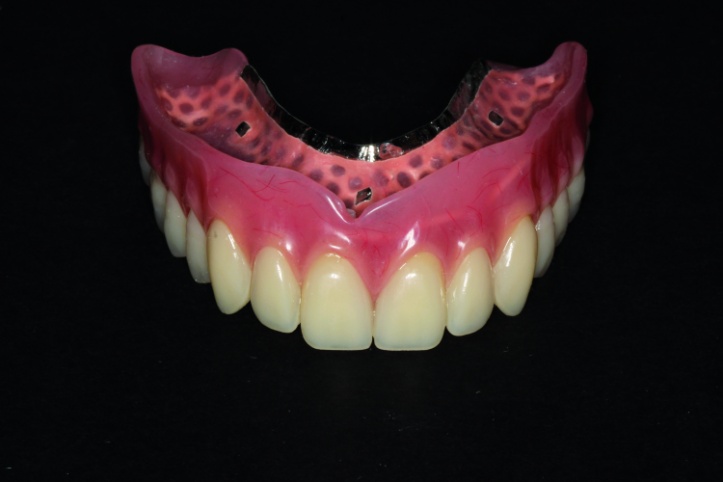 Dental News - The use of CBCT and CAD/CAM techniques in complex implant ...