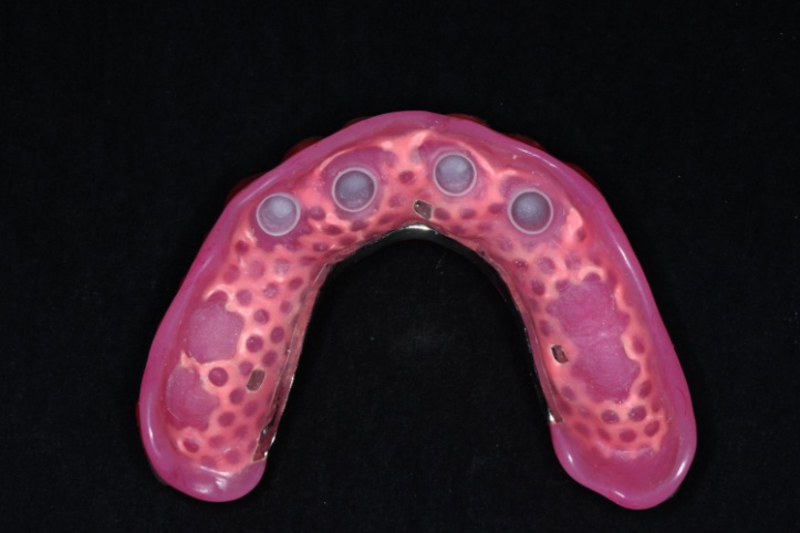 Dental News - The use of CBCT and CAD/CAM techniques in complex implant ...