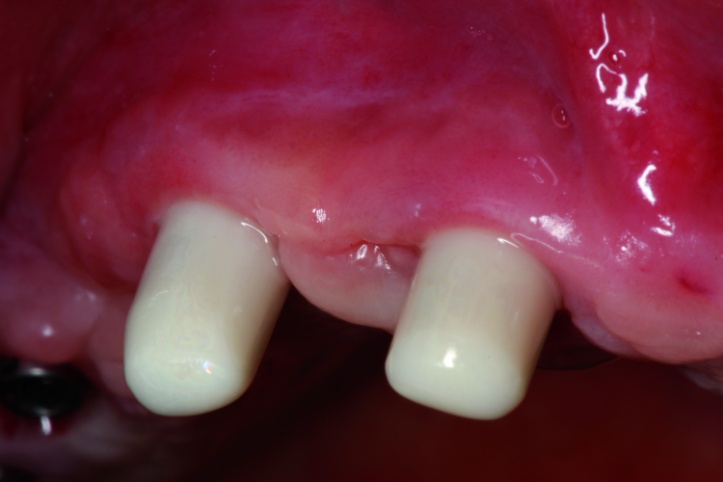 Dental News - The use of CBCT and CAD/CAM techniques in complex implant ...