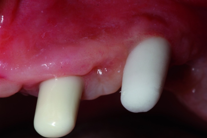 Dental News - The use of CBCT and CAD/CAM techniques in complex implant ...