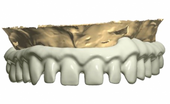Dental News - The use of CBCT and CAD/CAM techniques in complex implant ...
