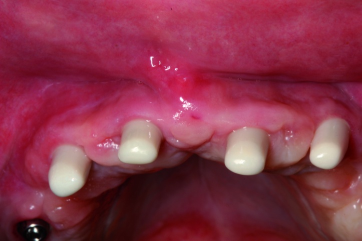 Dental News - The use of CBCT and CAD/CAM techniques in complex implant ...