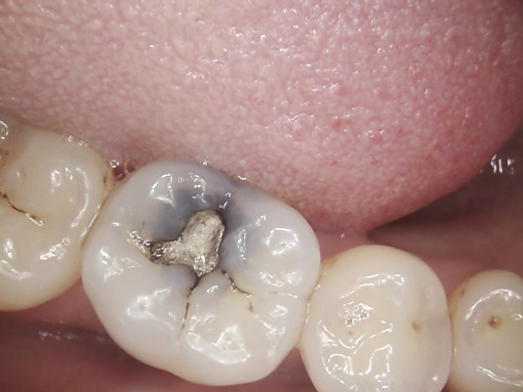 DT News MEA Removal of leaking amalgam restorations and placement of ceramic CAD/CAM inlays