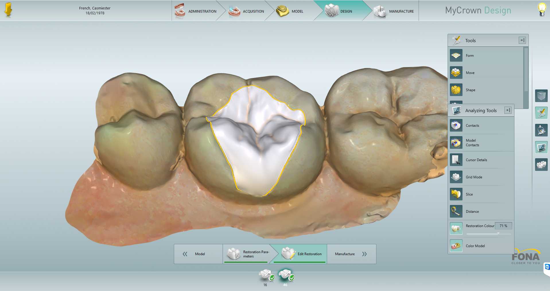 DT News - MEA - Removal of leaking amalgam restorations and placement ...