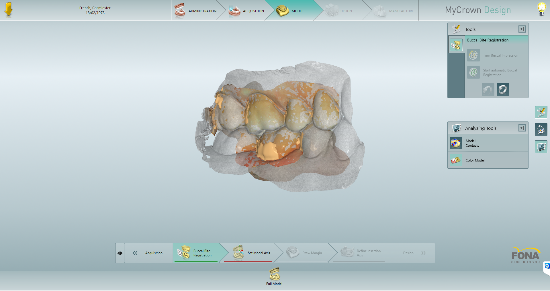 DT News - MEA - Removal of leaking amalgam restorations and placement ...