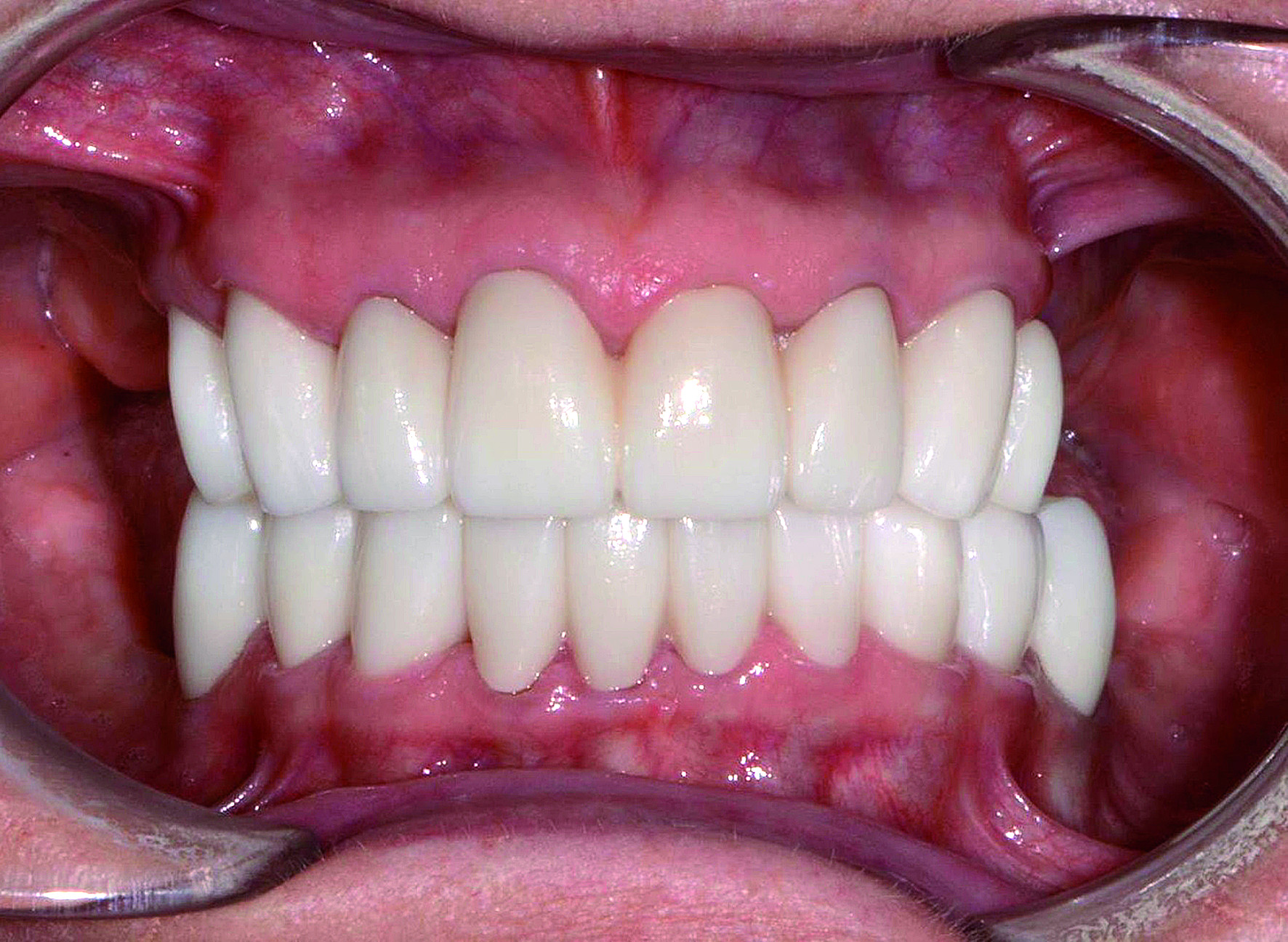Dental News - Using CAD/CAM for a combination approach to full mouth ...
