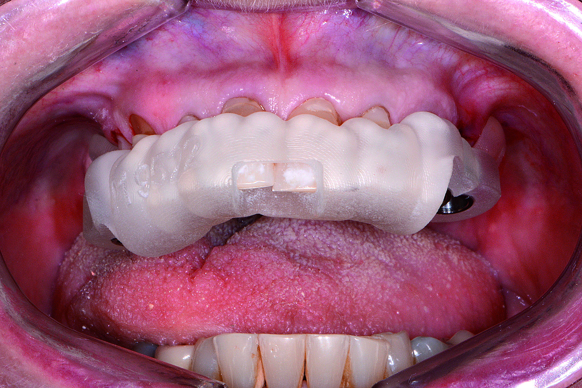 Dental News - Using CAD/CAM for a combination approach to full mouth ...