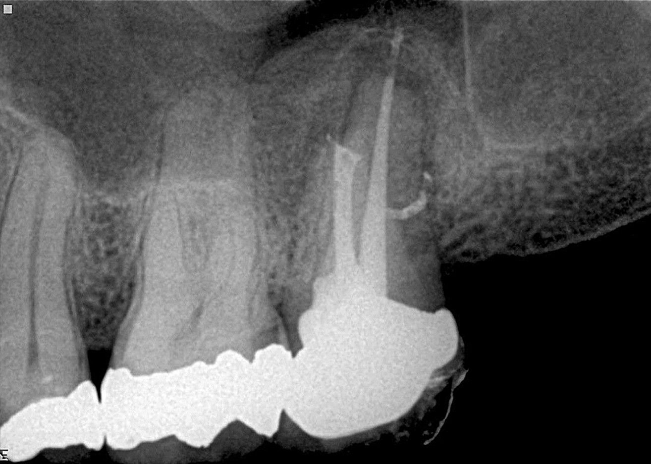 Dental News - The effect of partial vacuum on the chemical preparation ...