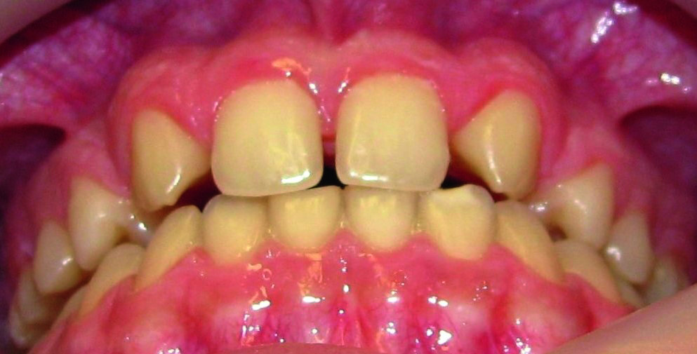 Dental News - Orthodontic management of maxillary lateral incisors agenesis