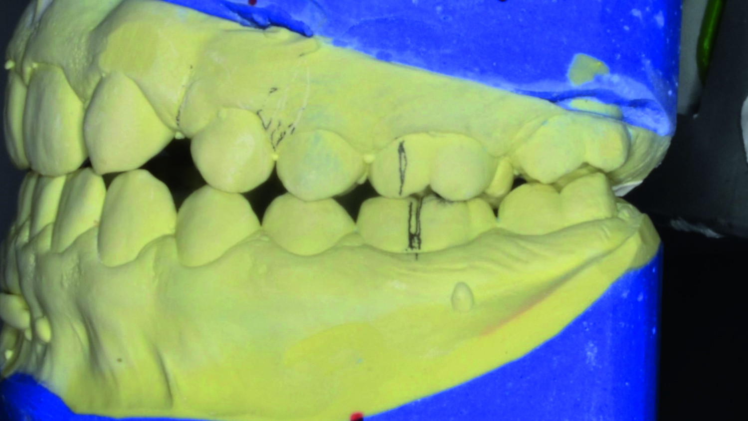 Dental News Orthodontic management of maxillary lateral incisors agenesis