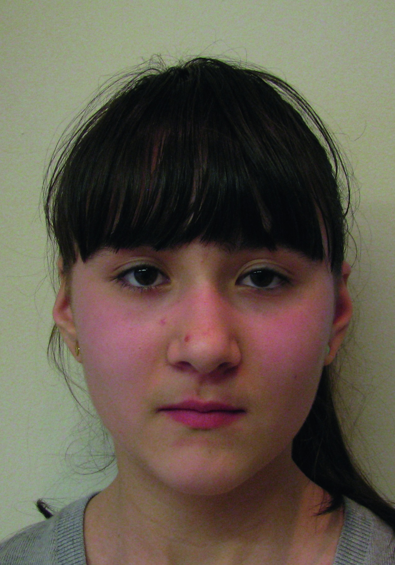 Dental News Orthodontic management of maxillary lateral incisors agenesis