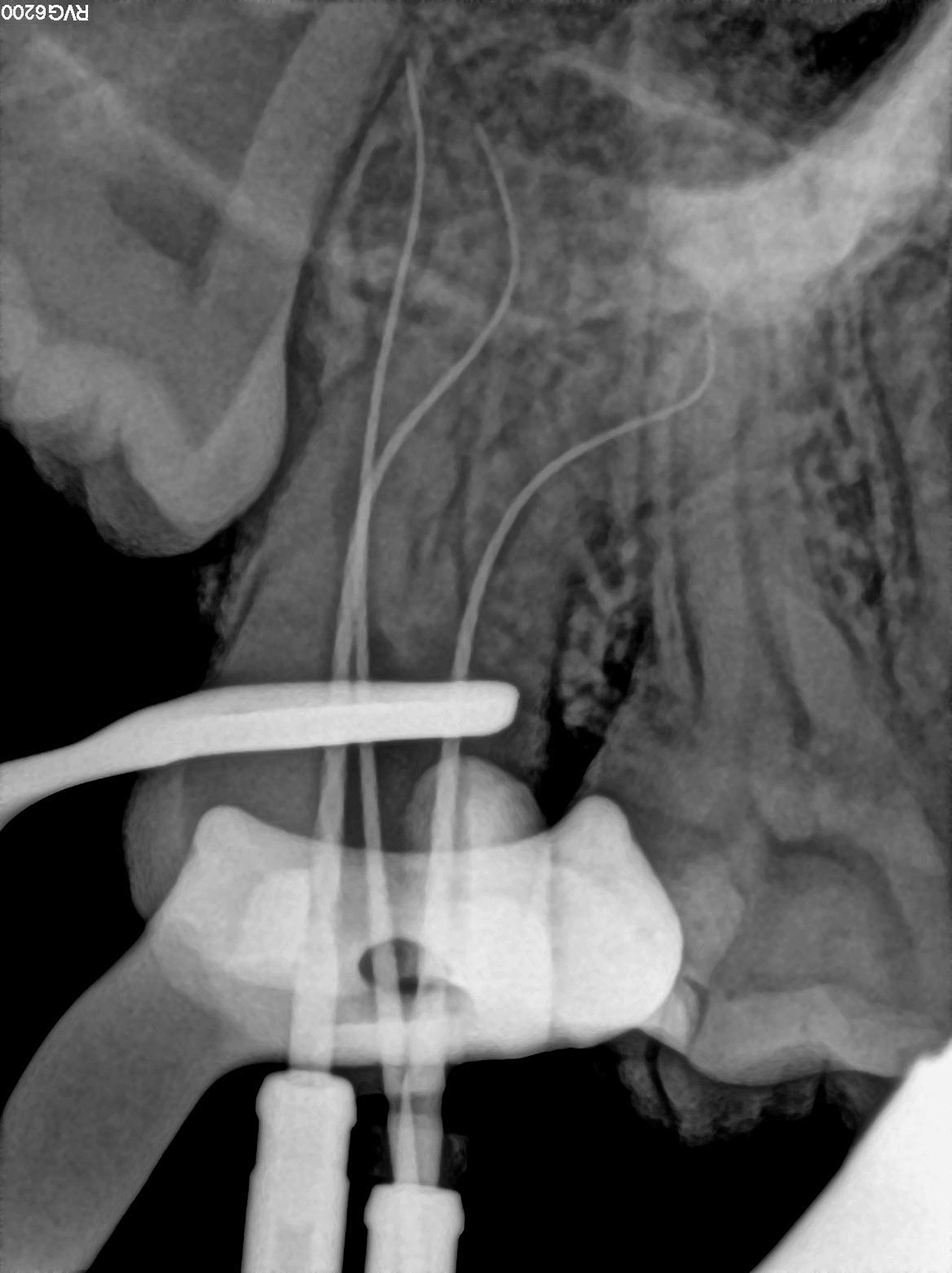 Endo Software Dental News - 3D Endo Software, glide path management and WaveOne Gold