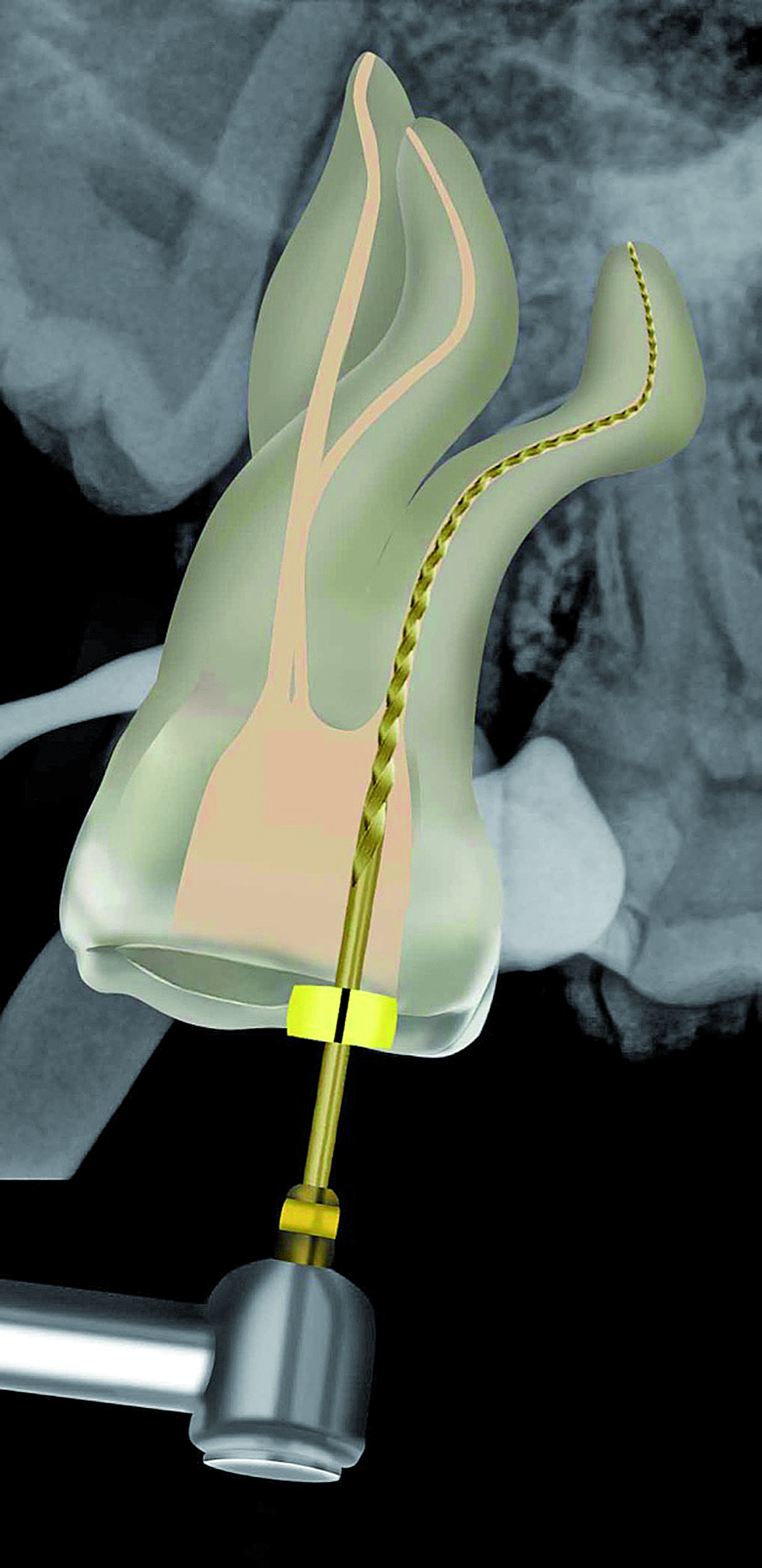 Waveone Gold Dental News - 3D Endo Software, glide path management and WaveOne Gold