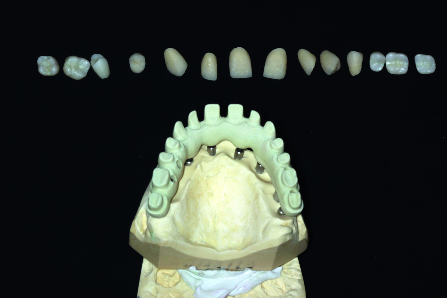 Dental News - The use of CBCT and CAD/CAM techniques in implant ...