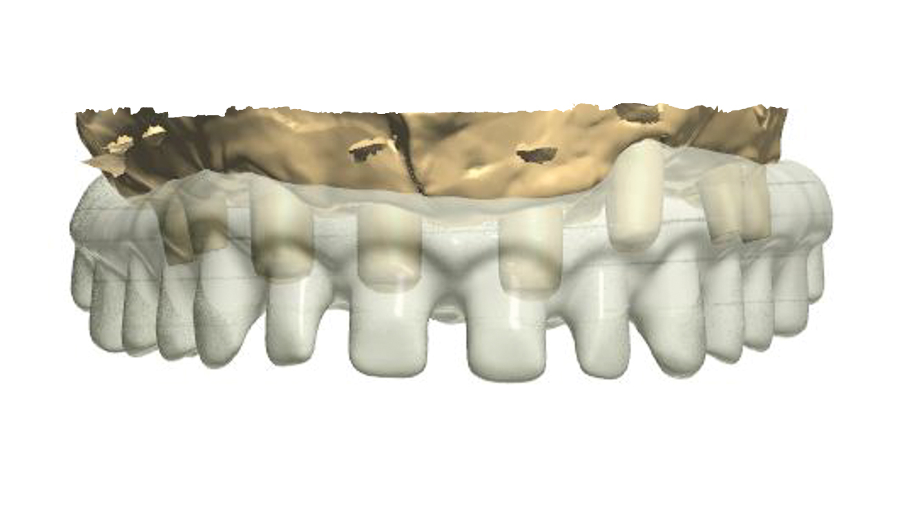 Dental News - The use of CBCT and CAD/CAM techniques in implant ...