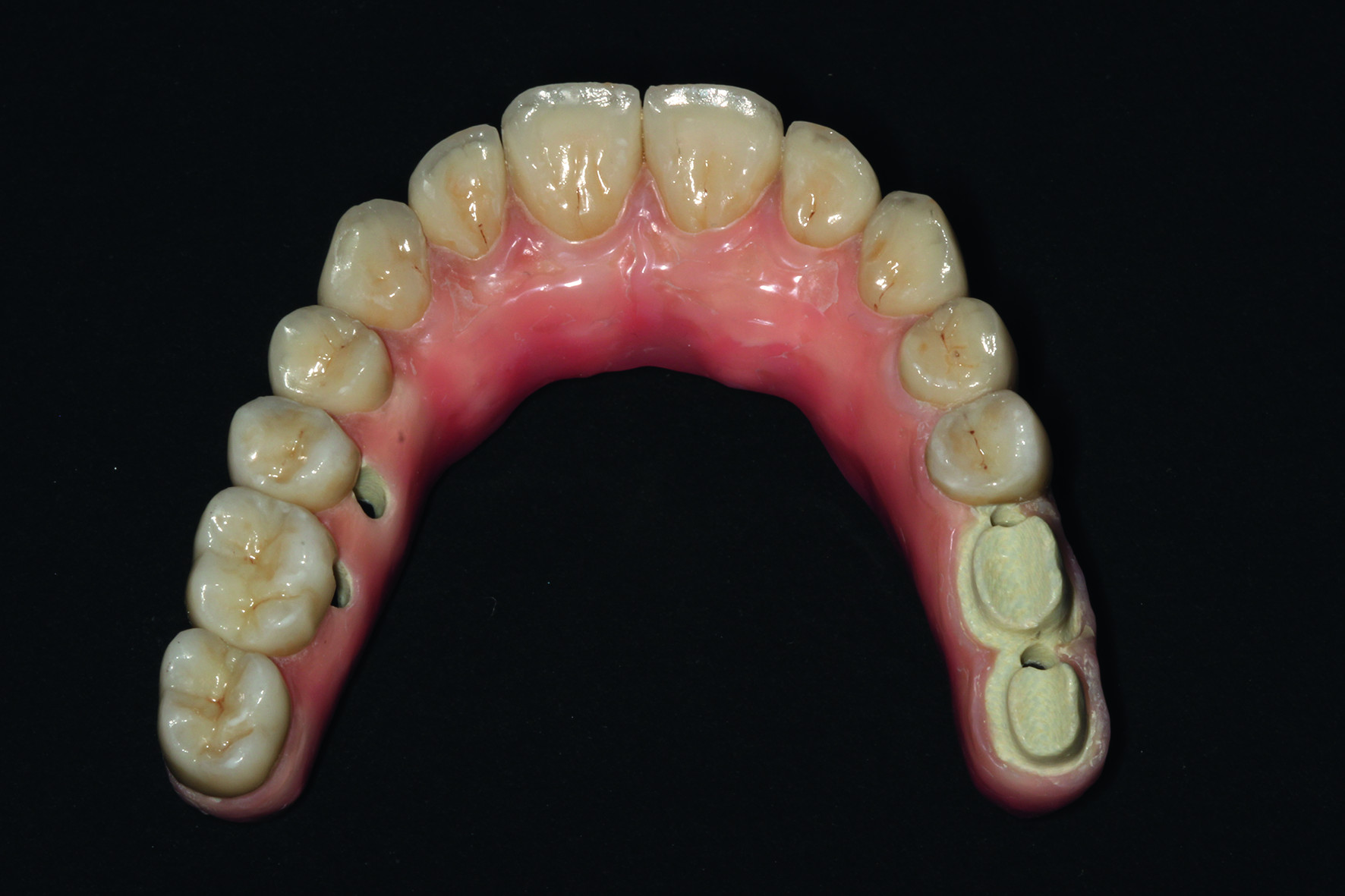 Dental News - The use of CBCT and CAD/CAM techniques in implant ...