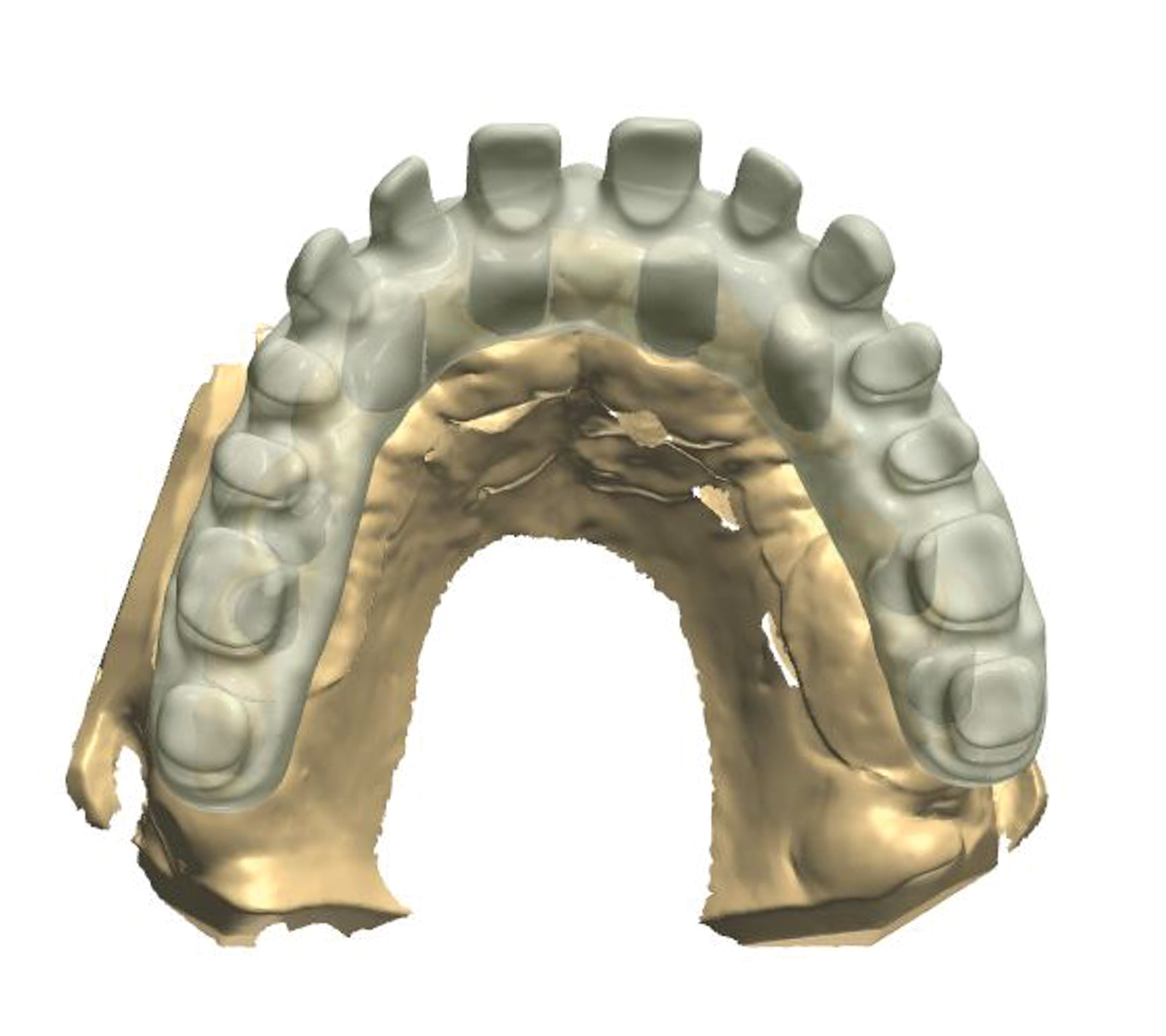 Dental News - The use of CBCT and CAD/CAM techniques in implant ...