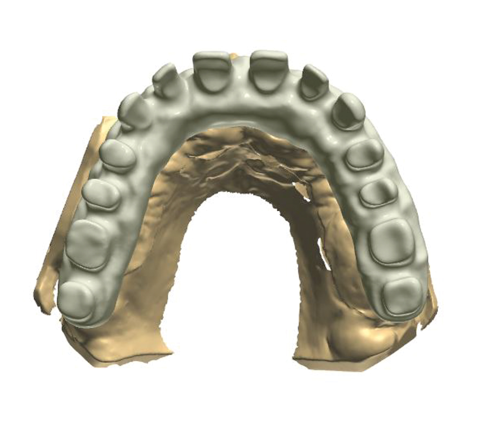 Dental News - The use of CBCT and CAD/CAM techniques in implant ...