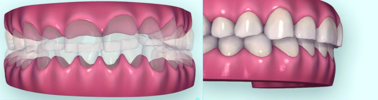 Dental News - Combined CAD/CAM-assisted treatment, for a new, beautiful ...