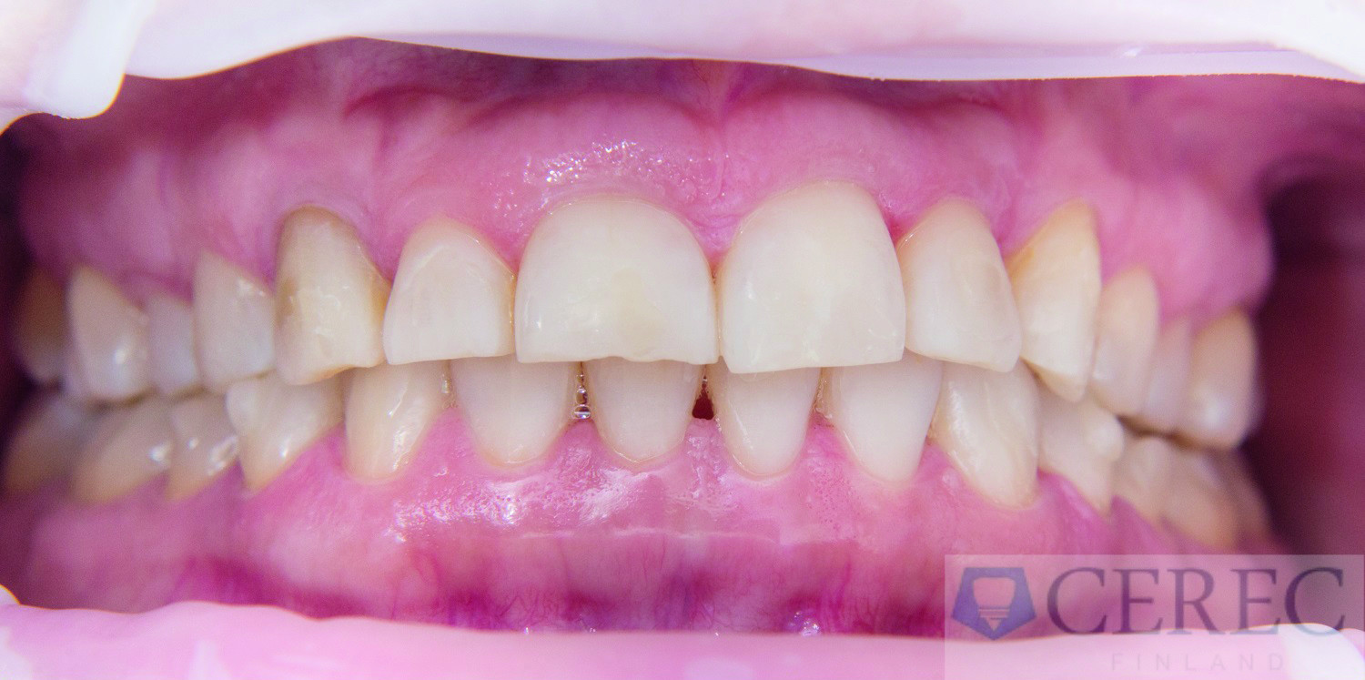 Dental News - Combined CAD/CAM-assisted treatment, for a new, beautiful ...