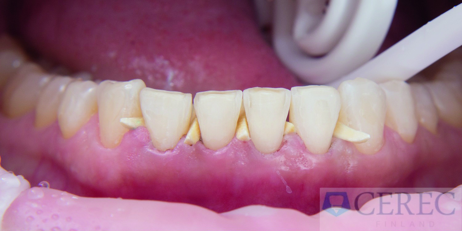 Dental News - Combined CAD/CAM-assisted treatment, for a new, beautiful ...