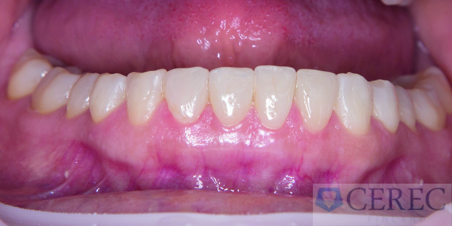 Dental News - Combined CAD/CAM-assisted treatment, for a new, beautiful ...