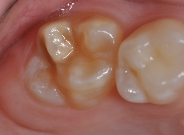 Dental News - Prevalence Of Mih Exceeds That Of Dental Caries Among 