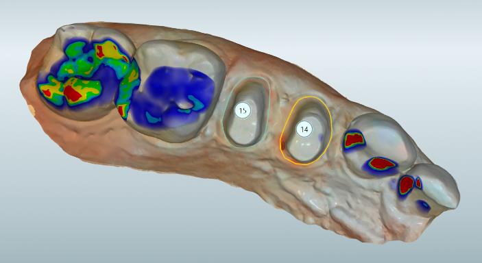 DT News - MEA - Substitution of two destructive caries with ceramic CAD ...