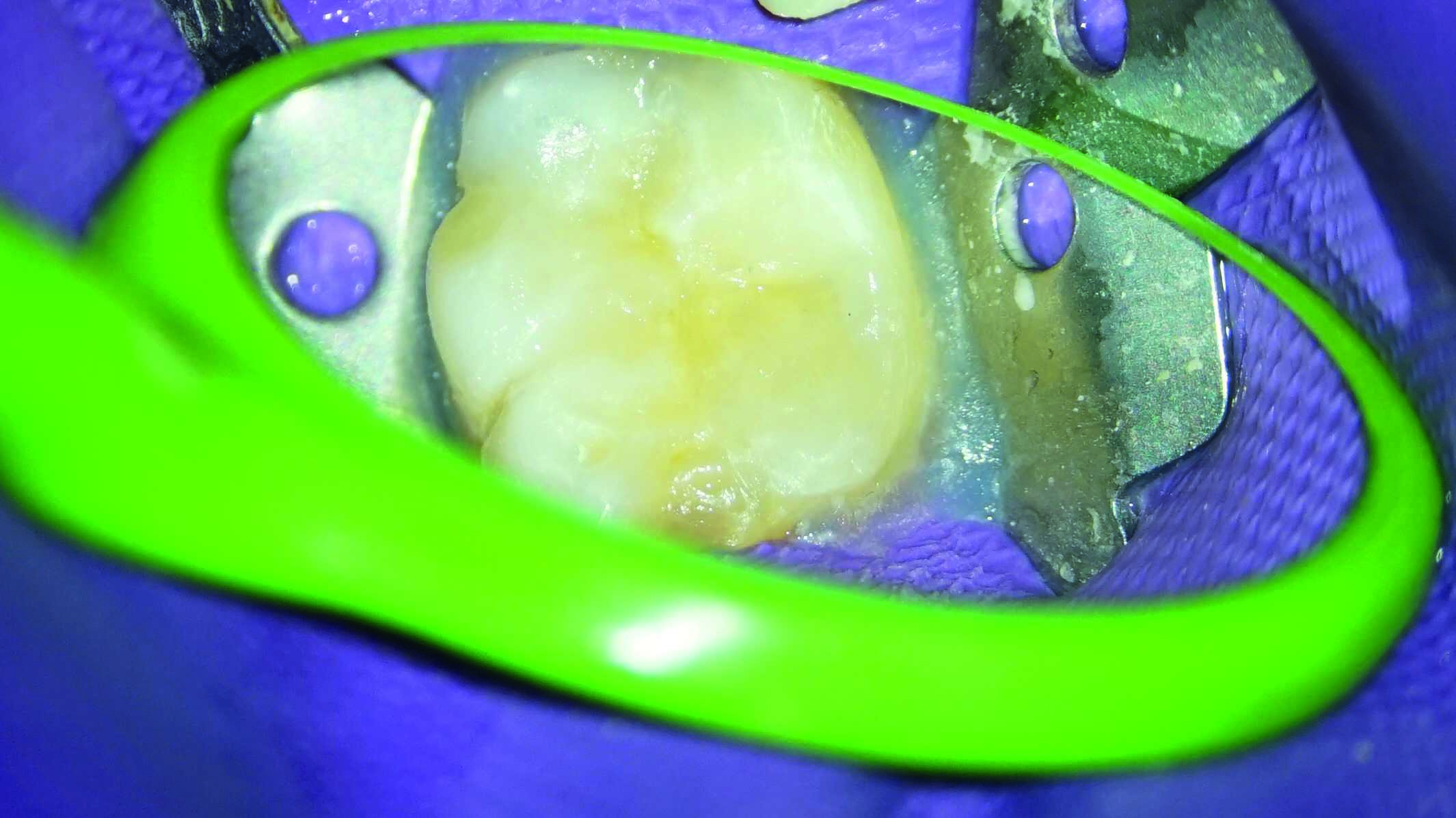 Dental News Direct pulp capping as a conservative procedure to