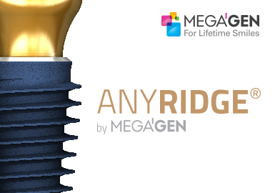 Image result for megagen AnyRidge