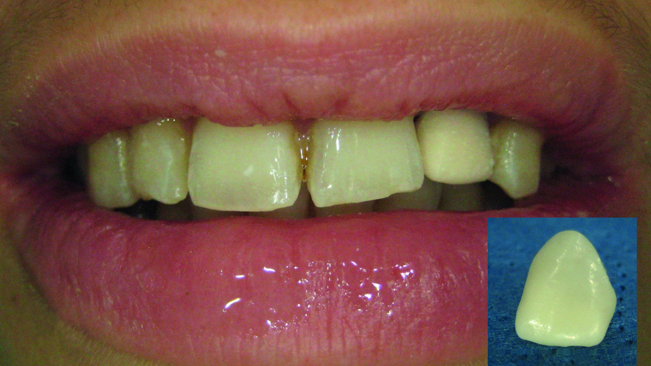 Dental News Optical impression and provisional prosthesis Proposal