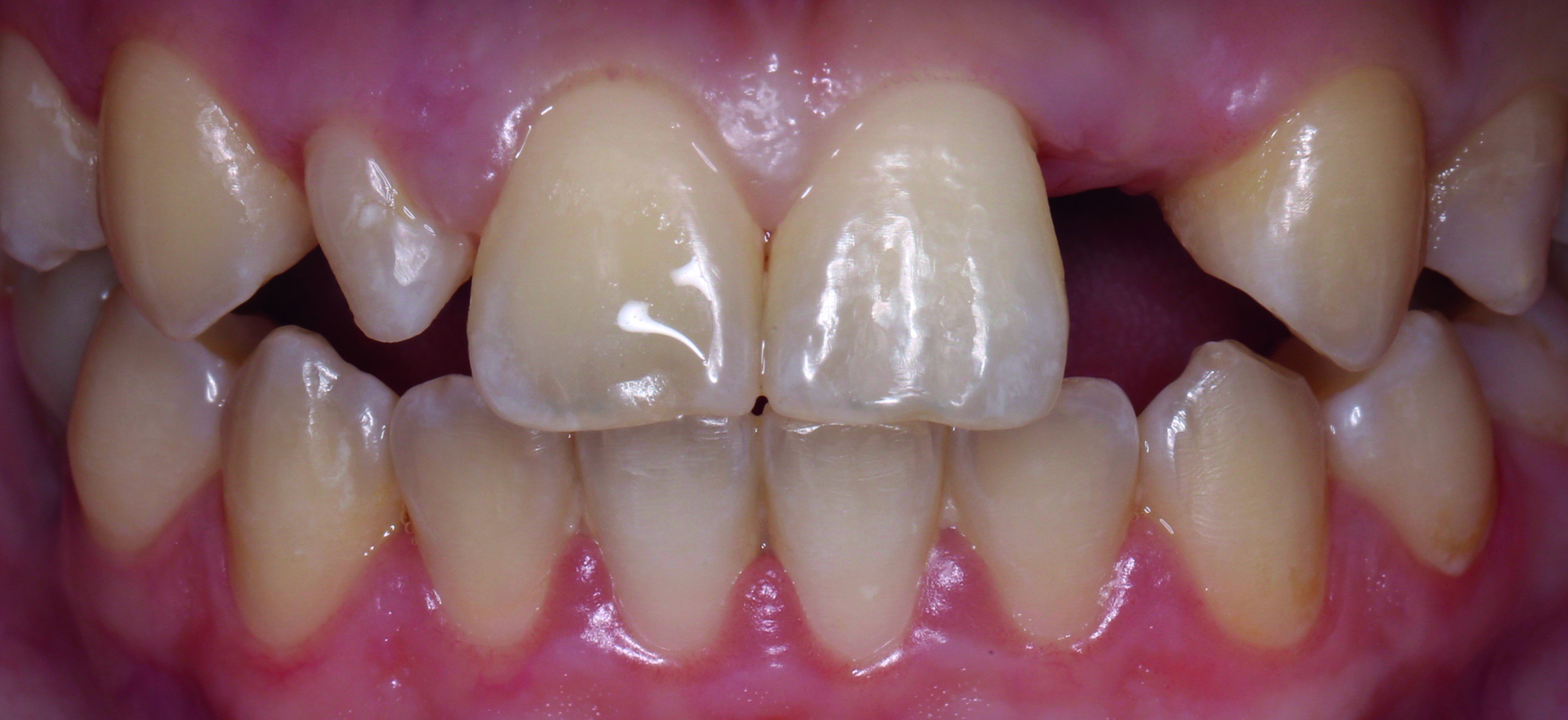 Dental News - The Complete Digital Implant Workflow