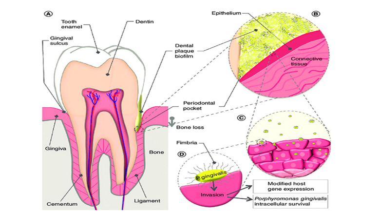 patogenia de la enfermedad periodontal slideshare