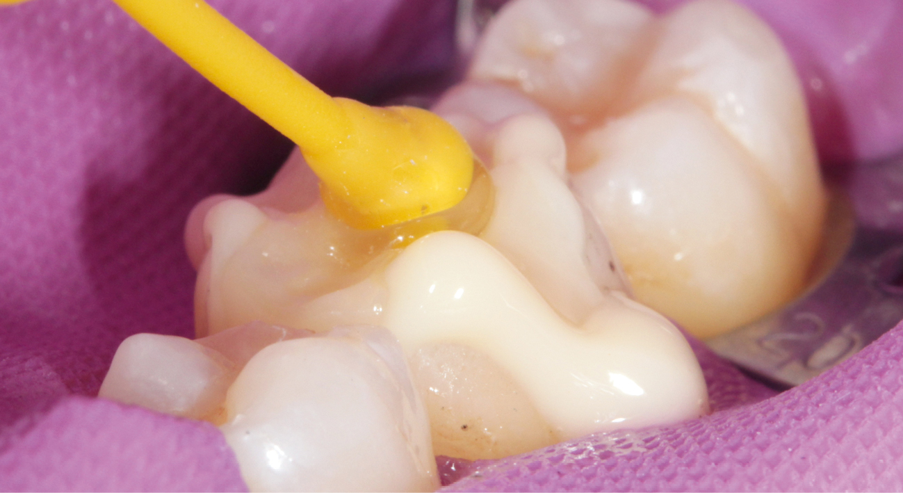 DT News - MEA - Easy and efficient: Composite resin blocks for the CAD ...