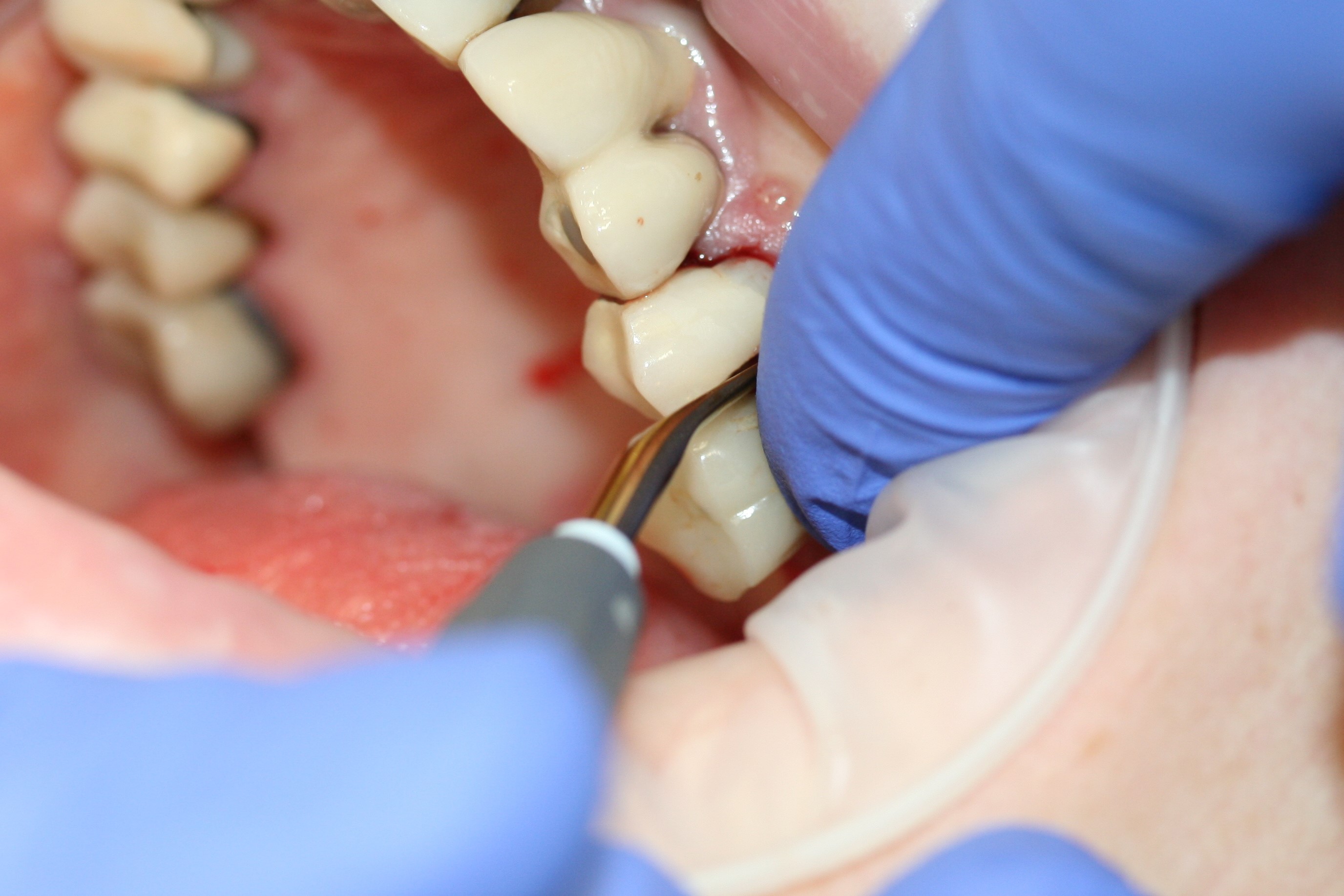 Dental News Atraumatic extraction of maxillary second premolar