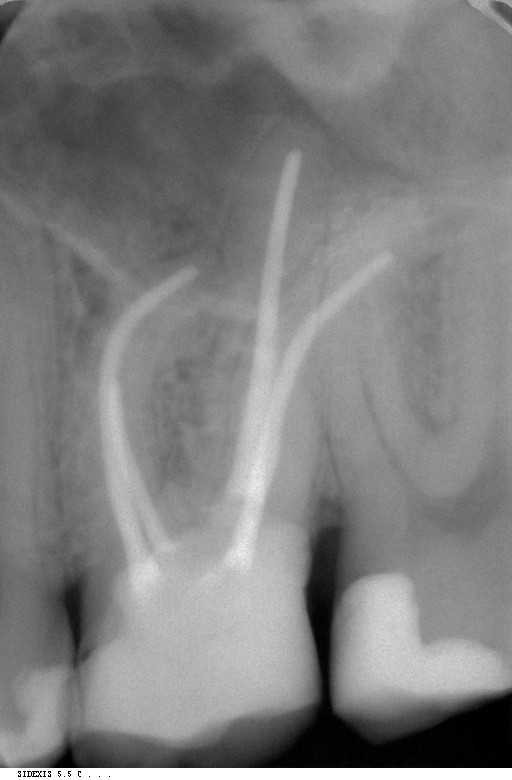 Dental News - Endodontic follow-up in strongly curved root canals