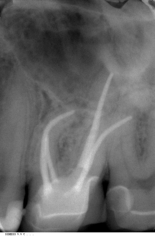 Dental News Endodontic followup in strongly curved root canals