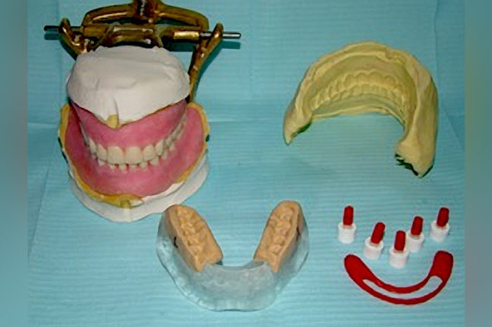 Fig. 30. Todo lo necesario previo a la cirugía y colocación de los implantes dentales: encerado diagnóstico, prueba estética, guía quirúrgica, guías de mordida, postes de impresión modificados, Guía vestibular de Putty, barra de Duralay OSU.