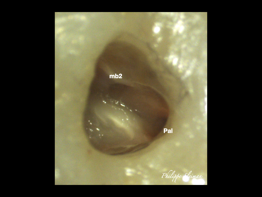 Dental News - Clinical management of maxillary second molar root canal ...