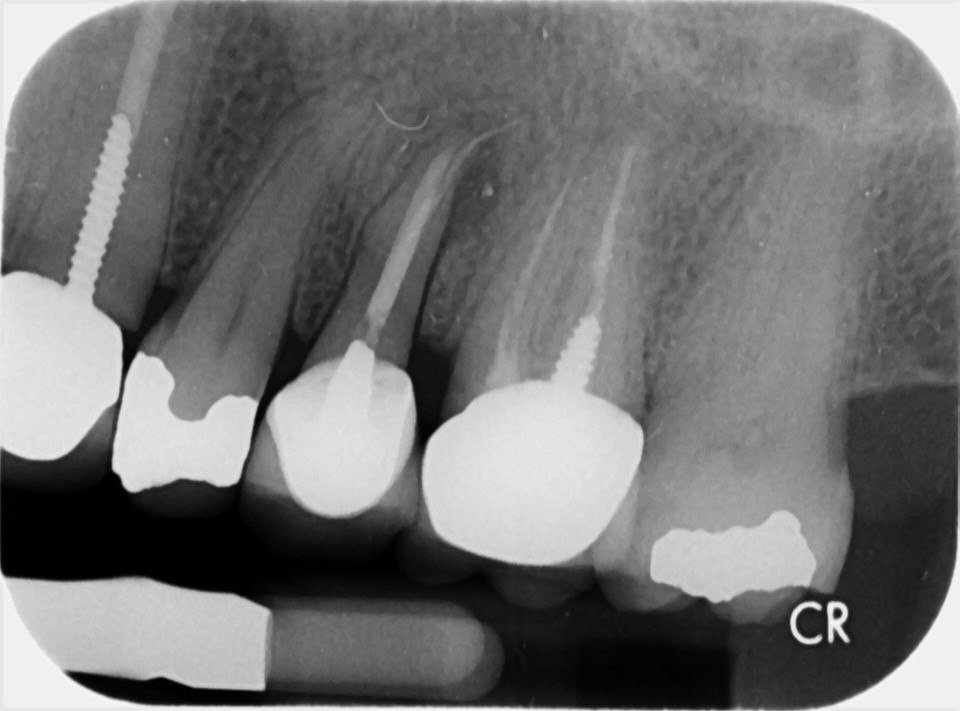 Buccal root of the bifurcated maxillary premolar—a danger zone during