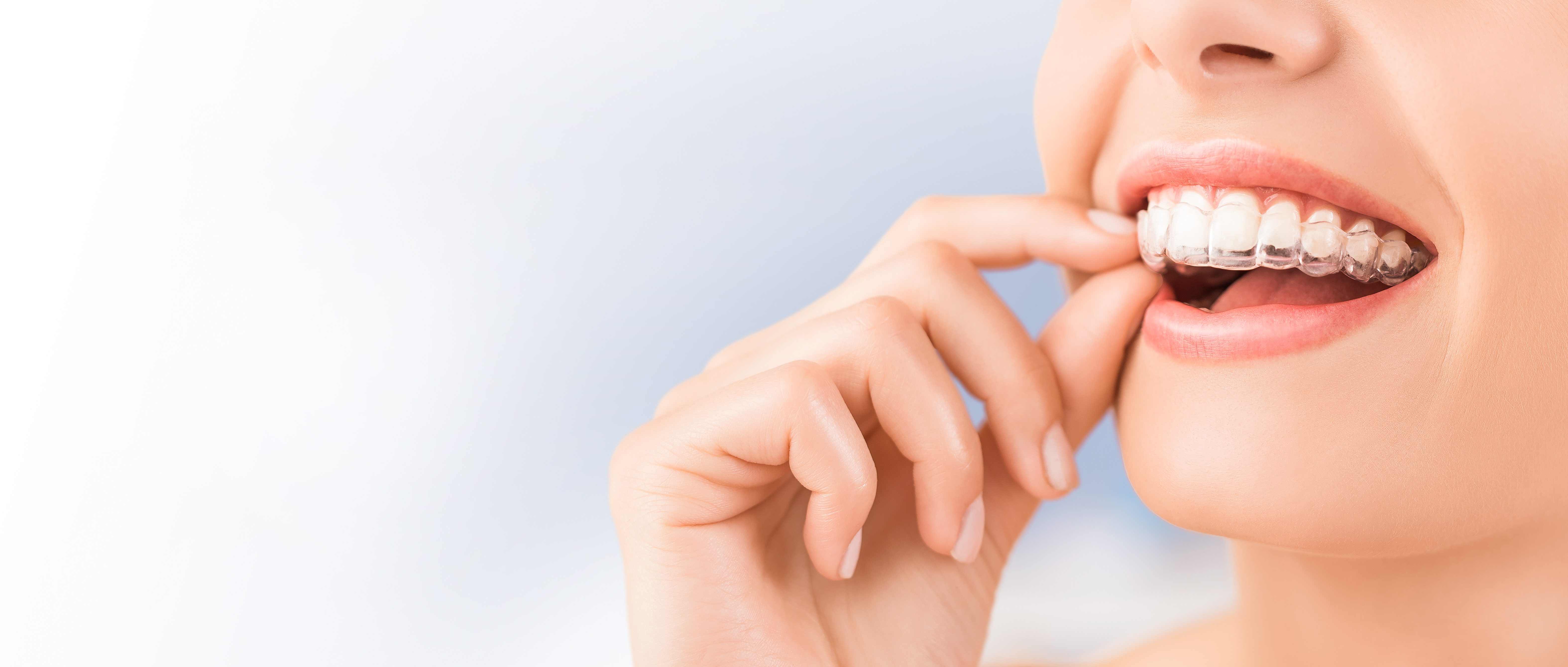 Allineatori in Terapia Ortodontica: Vantaggi e Svantaggi
