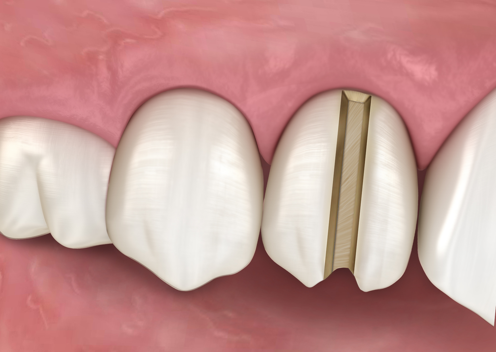 Eliminating the challenges of crown removal or endodontic access