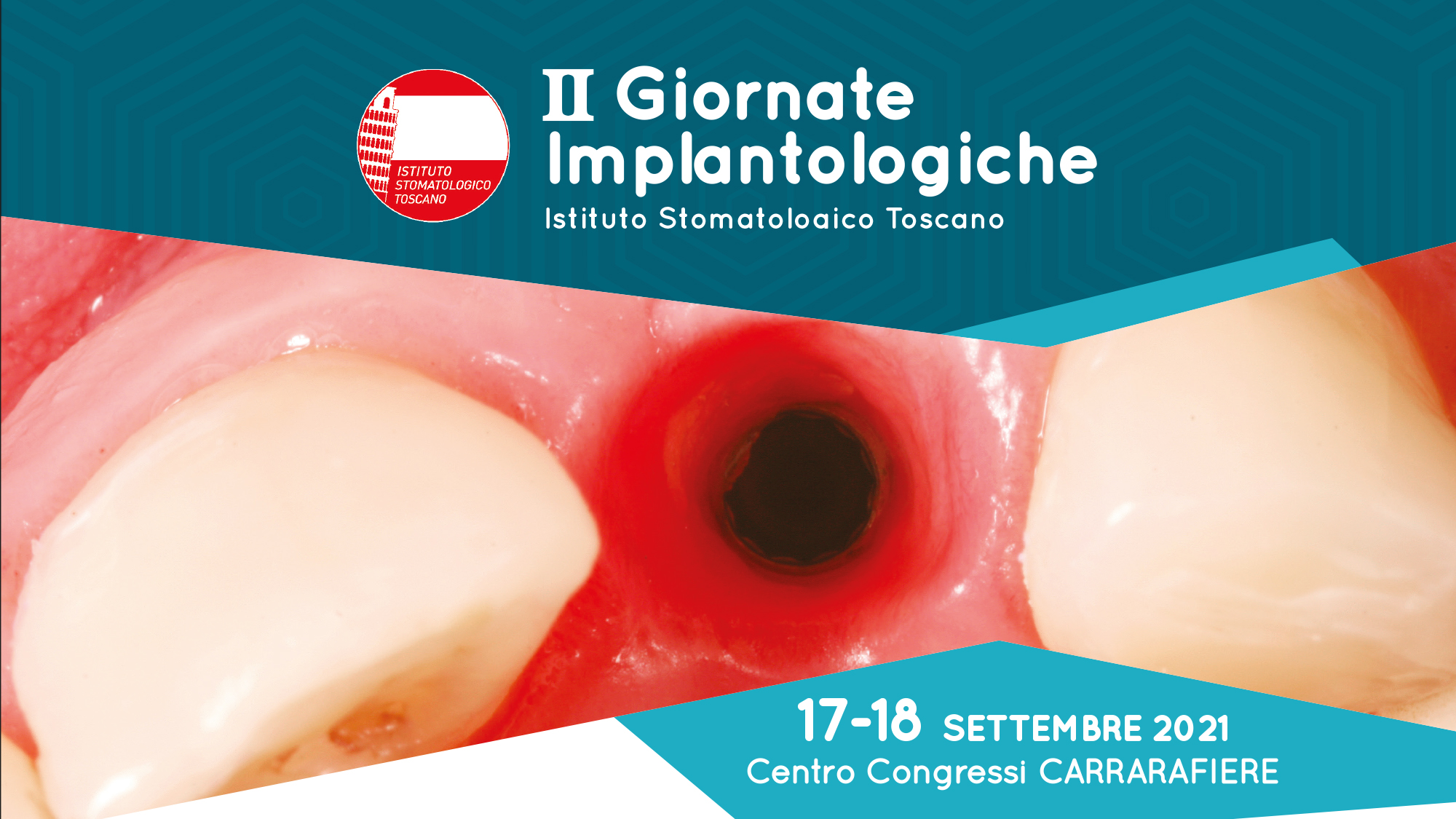 IL MANTENIMENTO DEI VOLUMI OSTEO-MUCOSI DOPO L’ESTRAZIONE DENTARIA – 17/18 settembre 2021