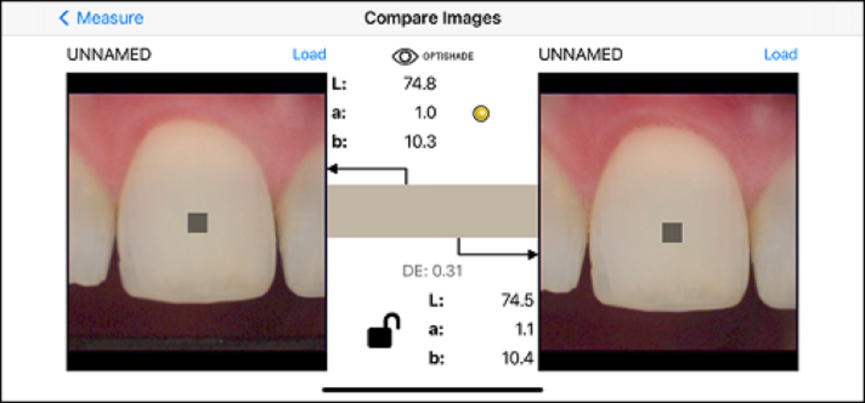 Digital dental shade measurement