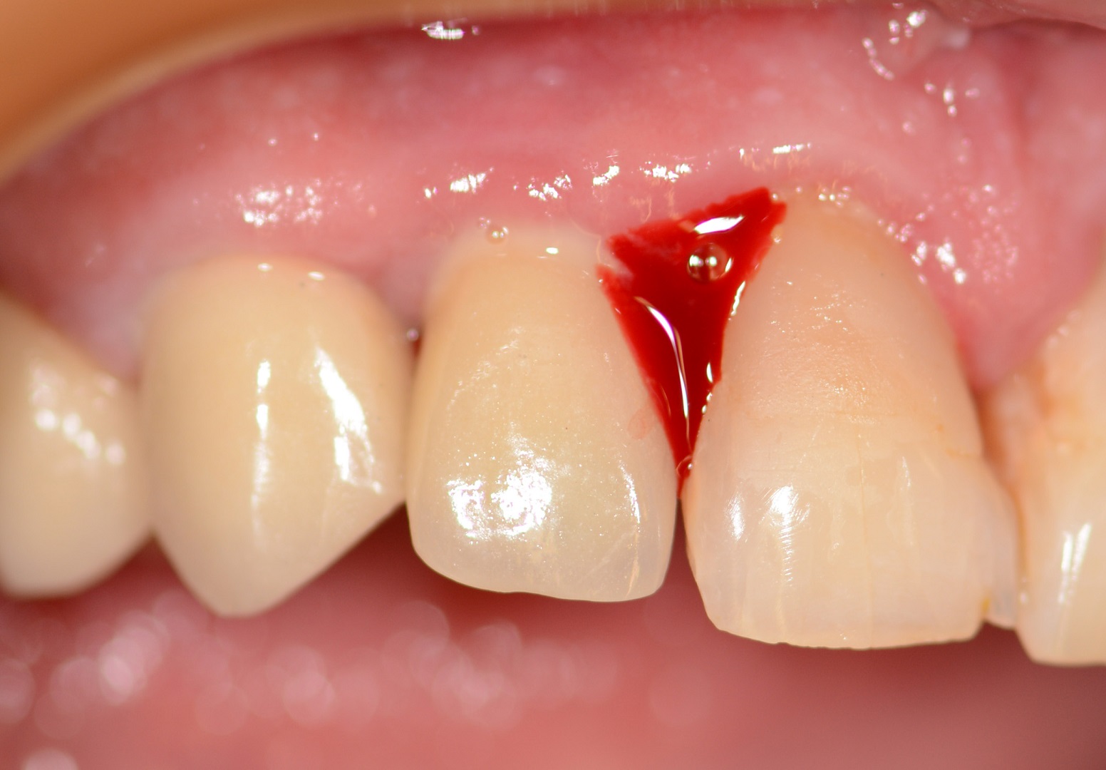 Dental News - Interview: Laser Protocol For Peri-implantitis Treatment